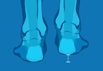 leg length discrepancy area