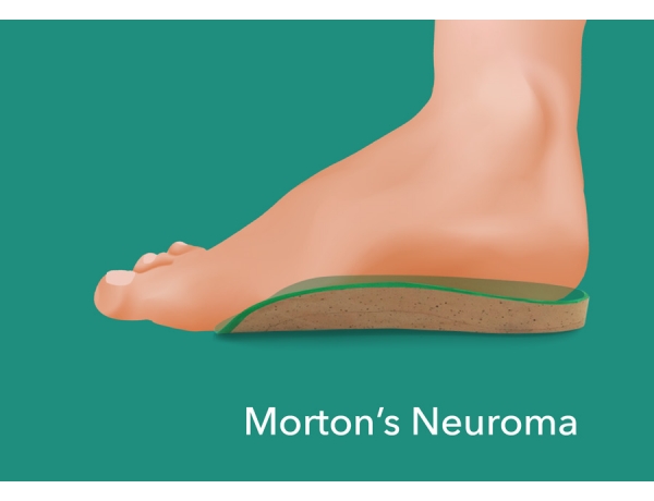 best insoles for morton's neuroma