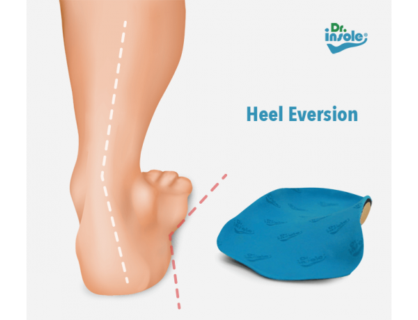 Custom made insoles for Heel Eversion