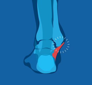 ankle sprain illustration