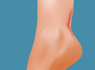 heel rupture illustration