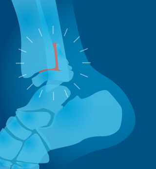 ankle fracture