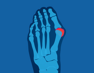 Bunions x-ray illustration