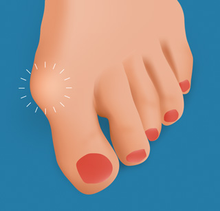 bunion drawing