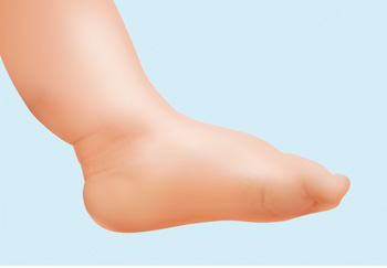 flat feet children