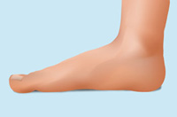 flat feet in adults