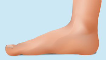 flat feet in adults