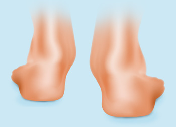 over-pronation of the foot