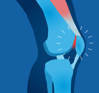 runner's knee illustration