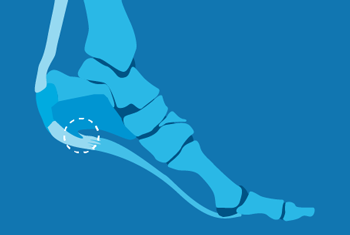 What is heel spur