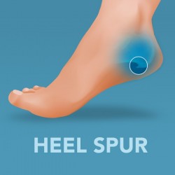 Heel Spur Orthotics