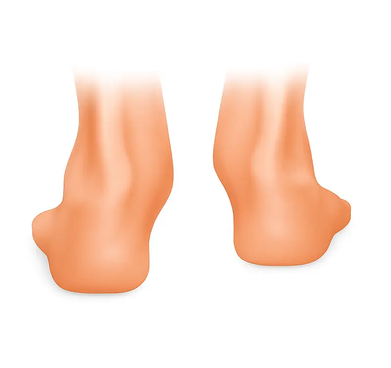 Illustration showing leg length discrepancy with uneven heel height, used by Dr Insole for education and orthotic support.