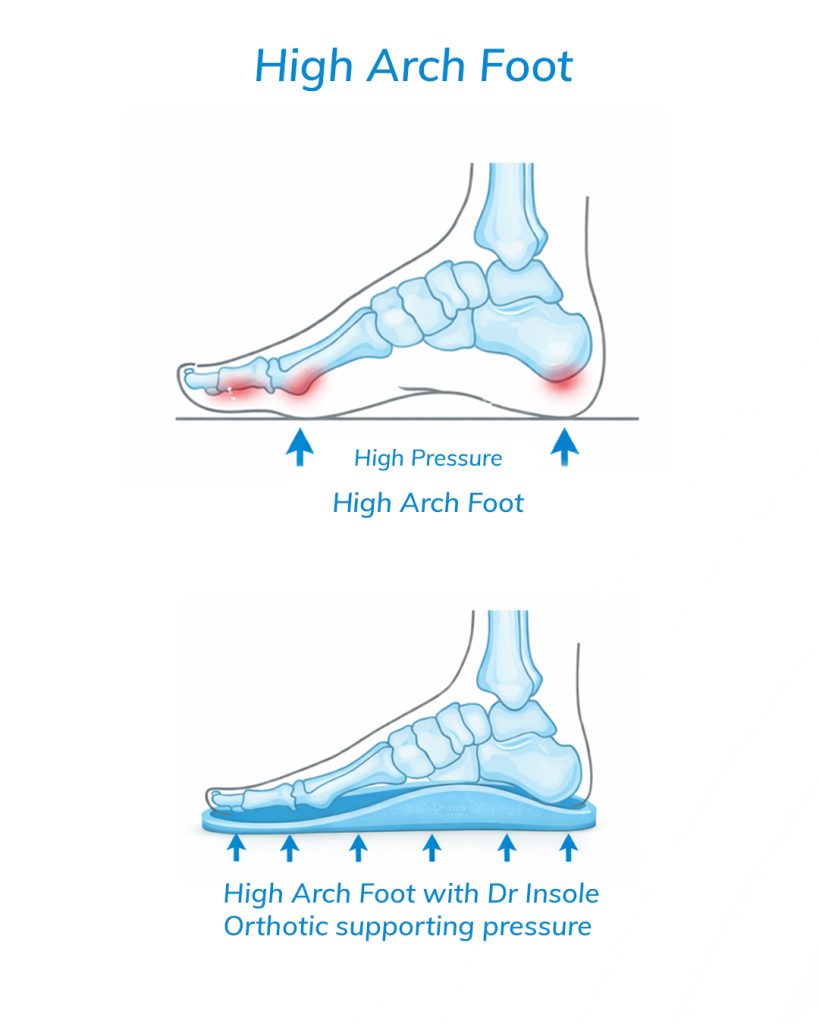Skeletal teen high arch foot supported by a light blue orthotic insole showing even pressure distribution.